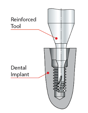 Fogászati implantátum